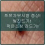 쯔쯔가무시병 증상!, 털 진드기!, 작은 소참 진드기!