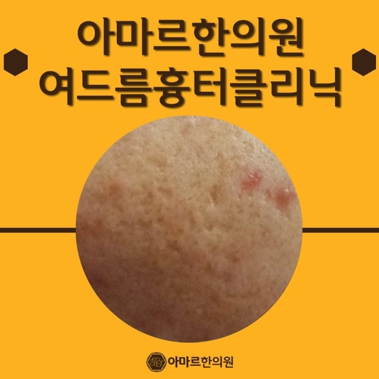 볼여드름흉터, 채울수 있어요. : 네이버 블로그