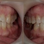 치아사이가 벌어졌어요 투명교정 27주 전후 사진