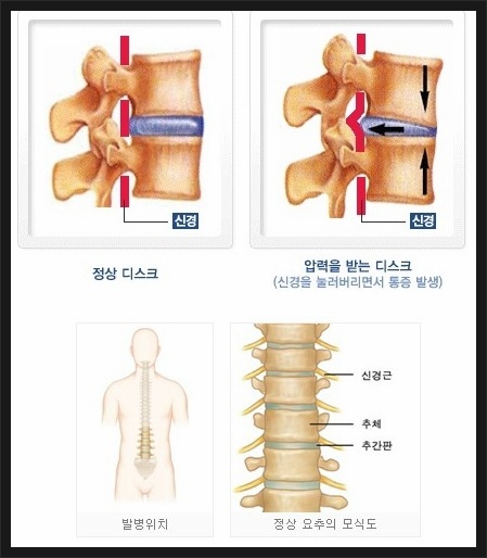 Discography(추간판조영검사) : 추간판탈출 : 네이버 블로그