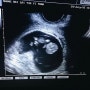[임신3개월] 9주 젤리곰 + 임신 초기 성별 확인법 (반지점,베이킹소다,적양배추) + 12주 1차 기형아 검사 선택