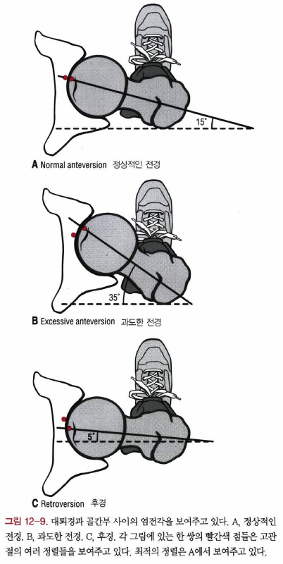 대퇴골의 염전각과 Craig test : 네이버 블로그
