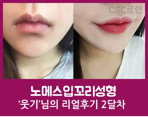 (입술필러, 입꼬리필러)웃기님의 노메스입꼬리성형 시술 2달차 후기 : 네이버 블로그