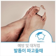 발톱 파고들때 이렇게 대처하세요~