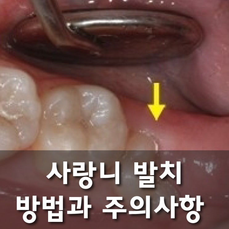 사랑니 발치 주의사항, 화곡 '더와이즈치과'가 알려드려요 : 네이버 블로그