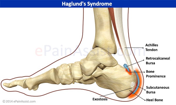 허글런드 변형(Haglund deformity) : 운동을 하면 발꿈치 뒤가 아프고 쉬면 좋아지지만 다시 시작하자마자 바로 아파 ...