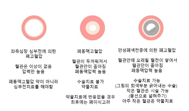 이해를 돕기위한 혈관 그림 : 폐동맥고혈압과 만성폐색전증에 의한 폐고혈압 : 네이버 블로그