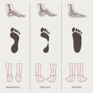 발의 변형 분류를 단순화시키는 것은 쉽지 않습니다.