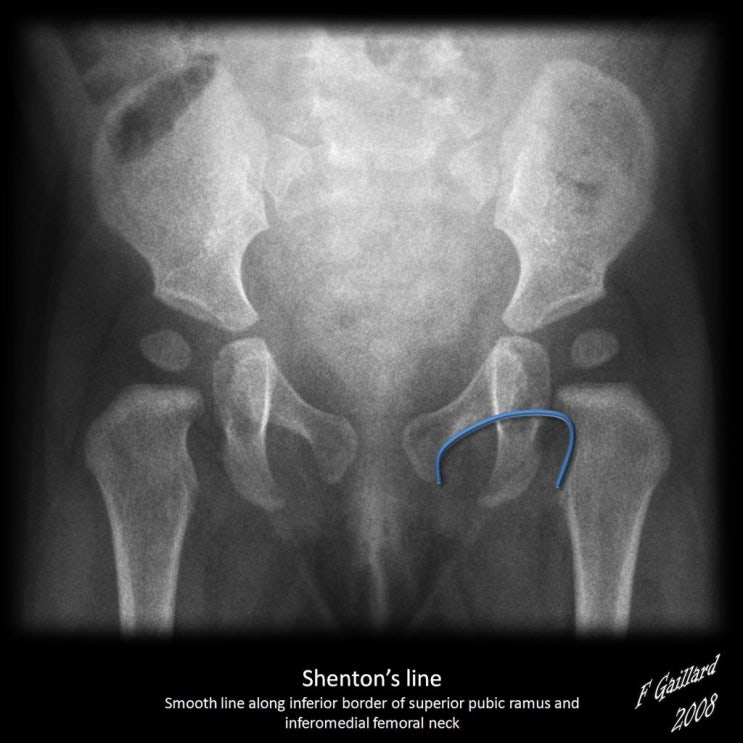 셴튼선 Shenton's line , Shentonsche Linie : 네이버 블로그