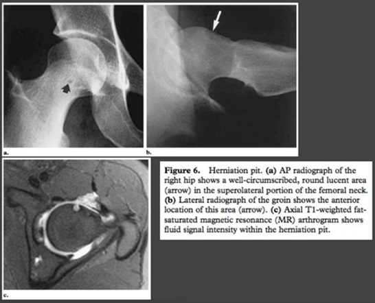 Herniation pit : 네이버 블로그