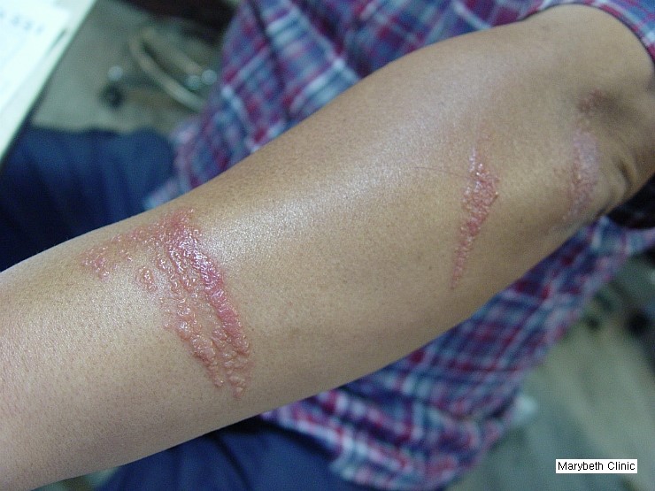 옻피부염(Rhus Dermatitis) 사진 : 네이버 블로그