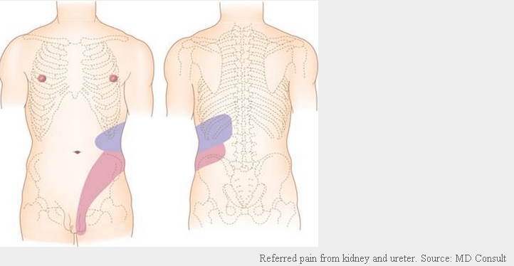 요로결석, 연관통, Nephrolithiasis, referred pain : 네이버 블로그