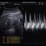 임신32주차-태동검사,32주 태아몸무게