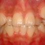 삐뚤거림이 심한 치아는 더 치아교정기간이 오래 걸리나요?[노원구 치아교정/강북구 교정전문/도봉구 치아교정/중랑구 치아교정전문치과]