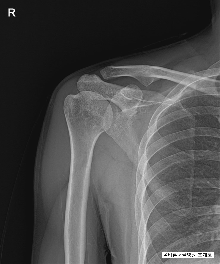 재발성 견관절 탈구(어깨 탈구)에서의 관절경적 방카트 복원술 (arthroscopic bankart repair with ...