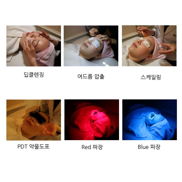 여드름 치료 _ PDT 프로그램 : 네이버 블로그