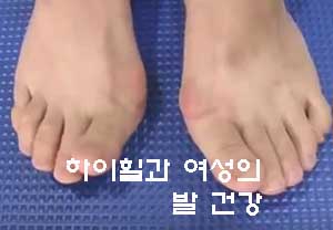 하이힐과 여성의 발 건강 : 네이버 블로그