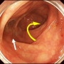 대장내시경 술기 X. 간만곡부, 상행결장 삽입이 어려운 경우의 대처