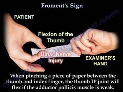 Froment's sign : 네이버 블로그