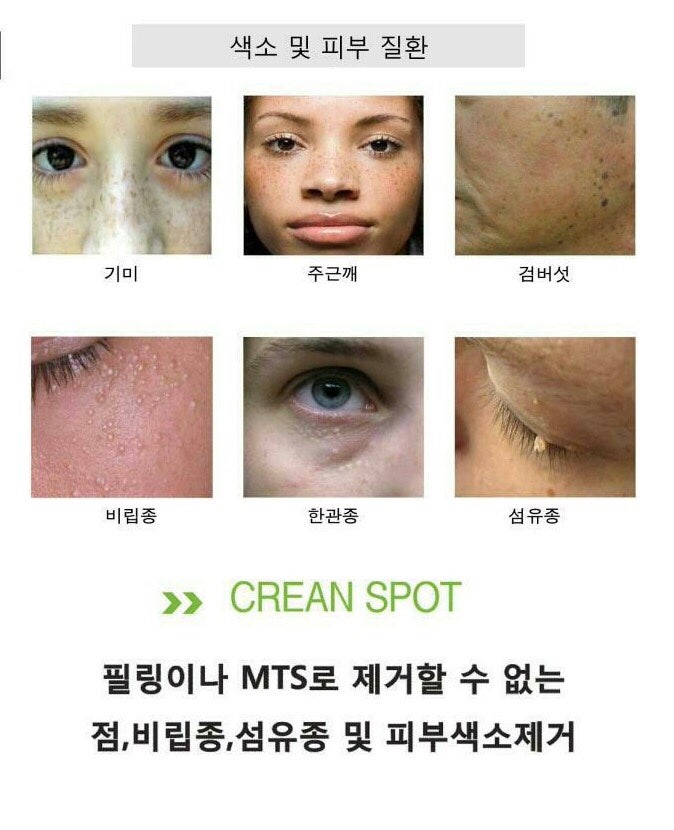 #비립종제거#물사마귀제거#얇은점제거#쥐젓제거#곤민하지마세요.#광주#반영구잘하는곳#비립종잘빼주는곳#제이올뷰티 : 네이버 블로그
