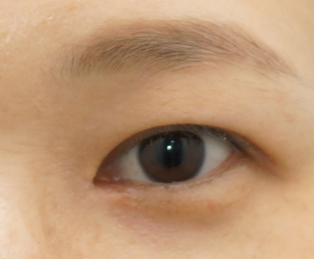 무쌍 눈매교정 vs 속쌍 눈매교정 - 민트성형외과 무쌍눈매교정 불가능한 경우는? : 네이버 블로그