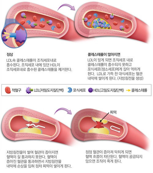 색전증과 혈전증 Embolus & Thrombus : 네이버 블로그