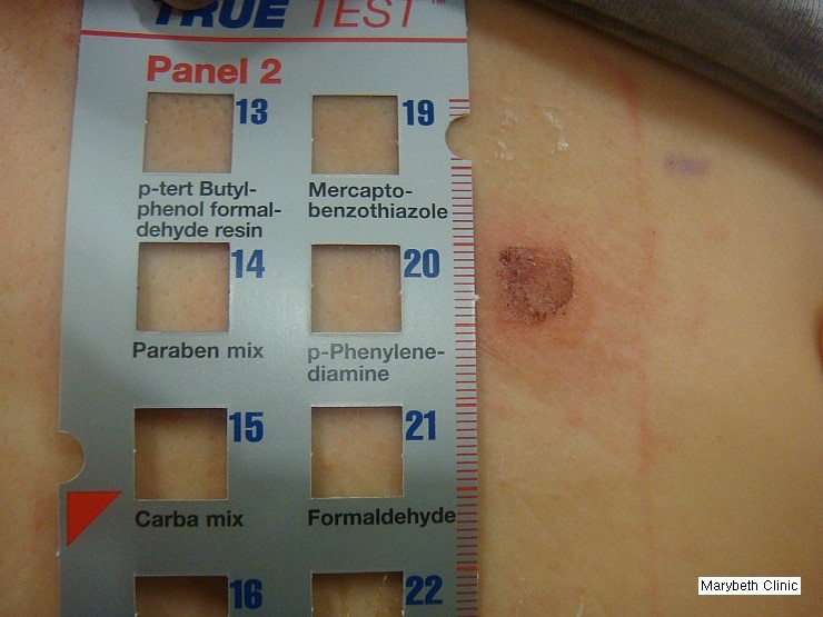 G. 첩포검사 주의사항 - (4) 첩포검사(patch test) - 진단 - 한국에 흔한 피부질환 [개정판] : 네이버 블로그