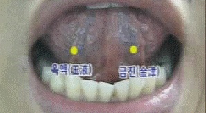 [강북 성북 도봉 노원 공휴일 진료 한의원] 금진옥액 사혈 시술 : 네이버 블로그