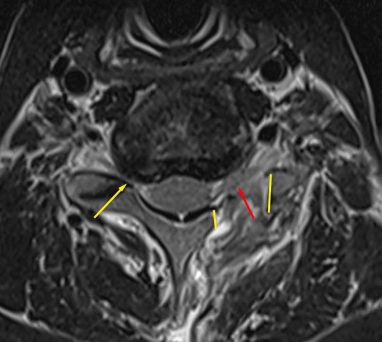 경추 후방 추간공 감압술(posterior foramintomy) (경추 추간공 협착증의 수술적 치료_Cervical ...