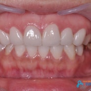 양재역치과 치아성형 시술후기