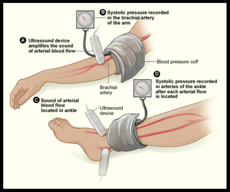 Ankle-Brachial Index(ABI) for assessment of peripheral arterial Disease ...