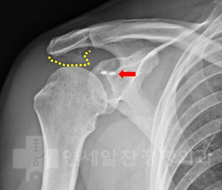 회전근개 파열, 슬랩 봉합술 후 상태에서 회전근개 봉합술 및 이두장건 고정술