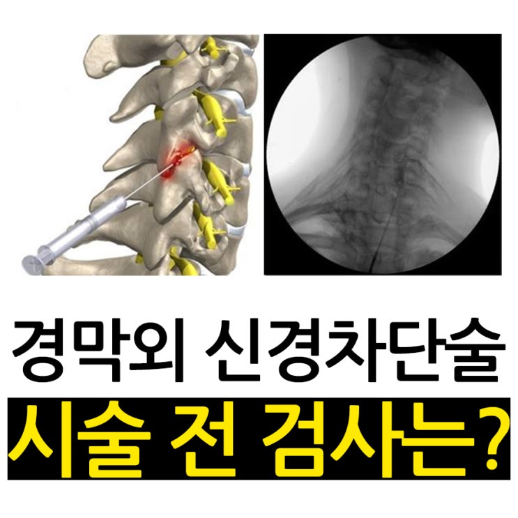경막외 신경차단술, 시술 전 검사 / 청주 디스크치료 : 네이버 블로그