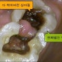 신경치료를 하다가 중단하면 어떻게 되나요? <선릉역치과>