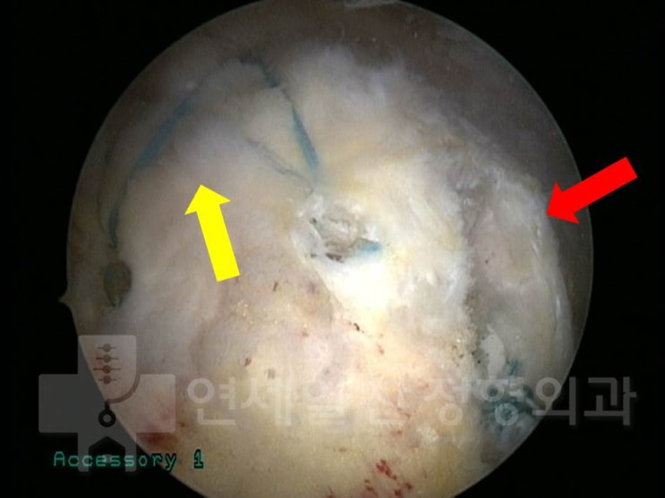 Supraspinatus Repair and Biceps Tenodesis for Partial Tears of the Supraspinatus and Long Head of Biceps with SLAP Lesion