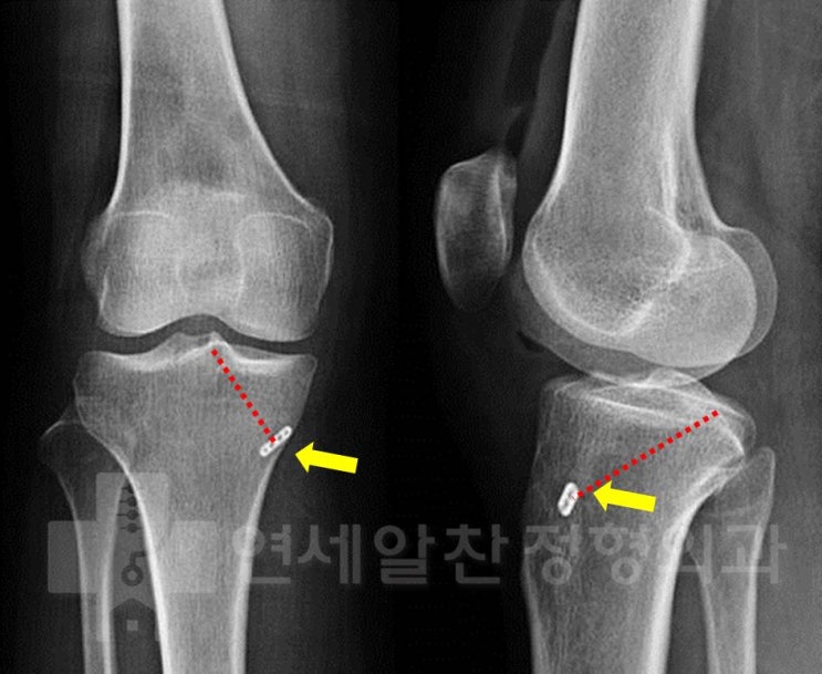 내측 반월상 연골 후각 기시부파열(Root tear) 및 내측 대퇴연골 손상 으로 Endo-button 을 이용한 기시부 봉합술 및 연골성형술