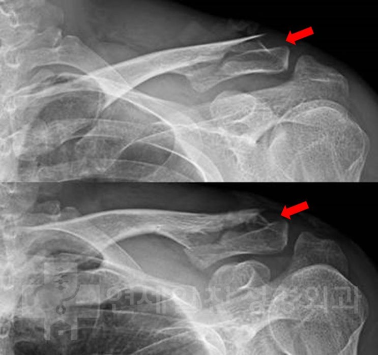 쇄골 원위부 골절에서 해부학적 금속판을 이용한 골절 수술