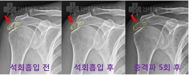 거대한 석회성건염 에서 석회 흡입주사 및 충격파 치료의 효과 및 결과
