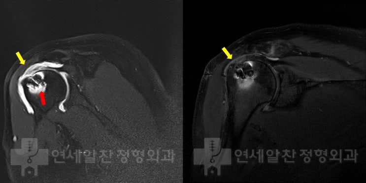 Rotator Cuff Revision Surgery and MegaDerm Augmentation After Re-tear Following Previous Repair