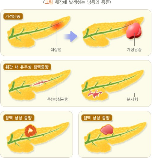 췌장 낭종, 고형 가 유두상종양이 암인지 여부 : 네이버 블로그