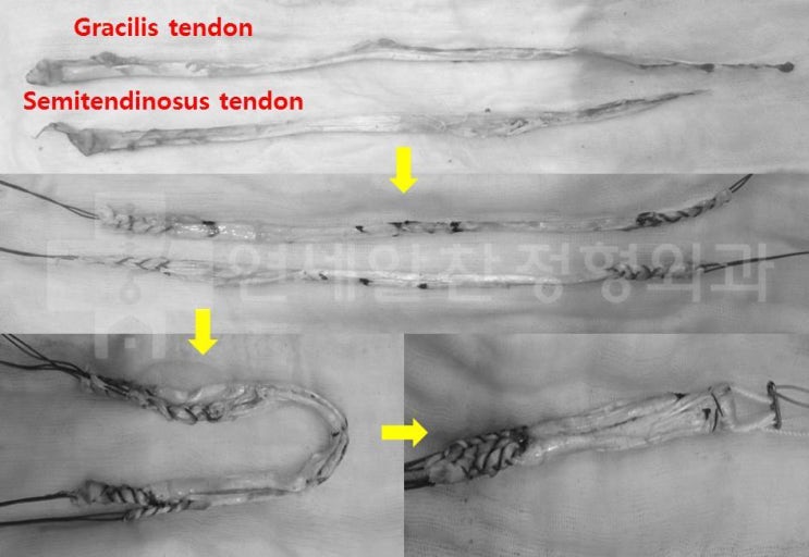 전방십자인대 완전파열로 자가건을 이용한 전방십자인대 재건술
