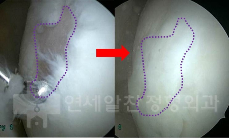 슬관절 퇴행성 관절염에서 근위교정절골술 및 줄기세포(카티스템) 치료의 결과