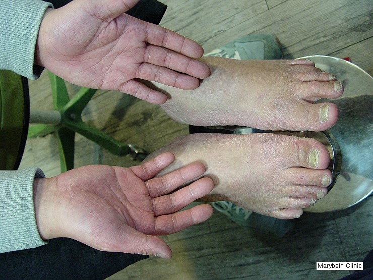 [참고] 무좀의 어원과 정의 - 제12장. 백선증(白癬症, Dermatophytosis) - 5. 발백선증(足部白癬, Tinea ...