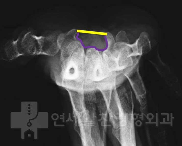 손목터널증후군(수근관증후군)에서 횡수근 인대 유리술 결과