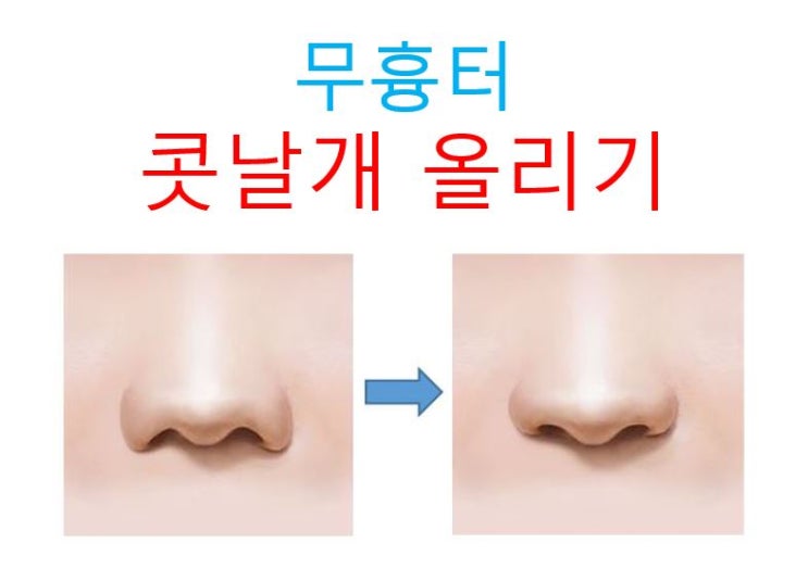 콧날개 올리기 : 효과적인 경우, 수술방법, 회복기간 : 네이버 블로그