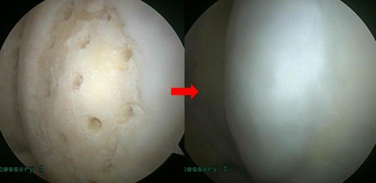 퇴행성 관절염에서 근위교정절골술(축교정술) 및 연골성형술의 결과