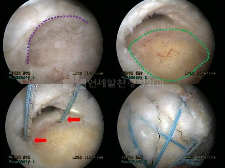 극상근파열, 충돌증후근 동반된 경우 경봉성형술 및 이열교량형 봉합법을 이용한 극상근 봉합술의 결과