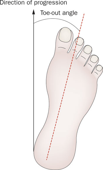 toe-out 보행(팔자걸음)의 역학적 원인 : 네이버 블로그