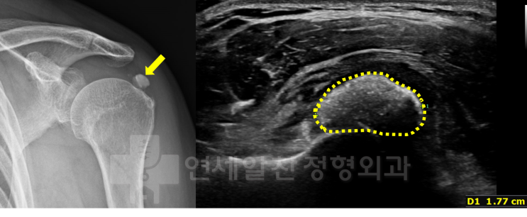 석회성 건염에서 관절경하 석회 제거술의 결과