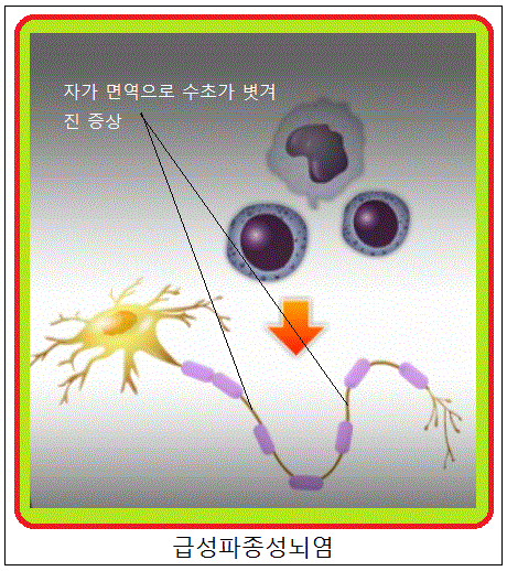 장간막혈관폐색증•급성복통증•급성불안신경증•급성뇌증후군•급성혼돈상태•급성혼동상태•급성망상정신병•편집증•망상장애•급성파종뇌염•급성 ...